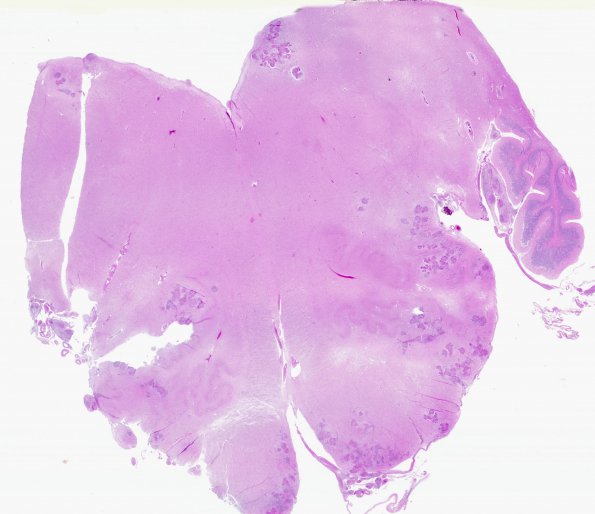 1G2 Neurosarcoidosis (Case 1) N19 H&E whole mount