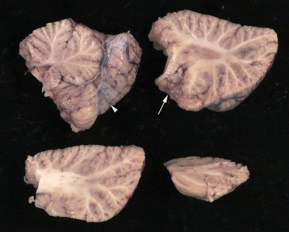 1H Neurosarcoid (Case 1) _28 copy