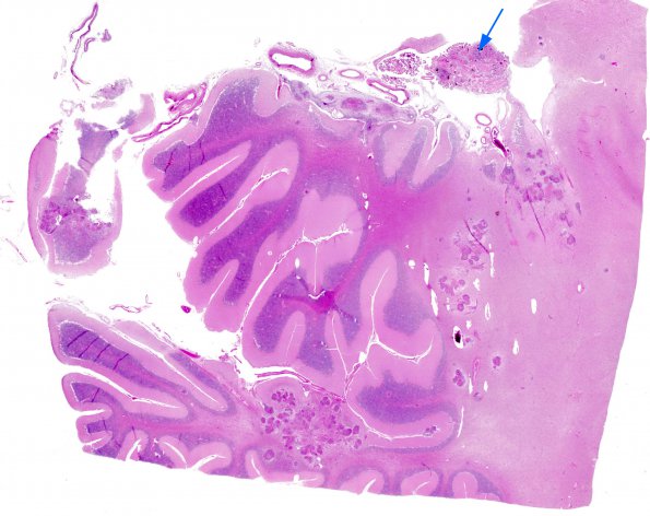 1I1 Neurosarcoid (Case 1) N9 H&E whole mount copy