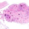 1I2 Neurosarcoid (Case 1) N H&E 3