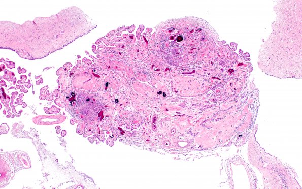 1I2 Neurosarcoid (Case 1) N H&E 3