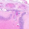 1I3 Neurosarcoidosis (Case 1) N9 H&E 2 copy