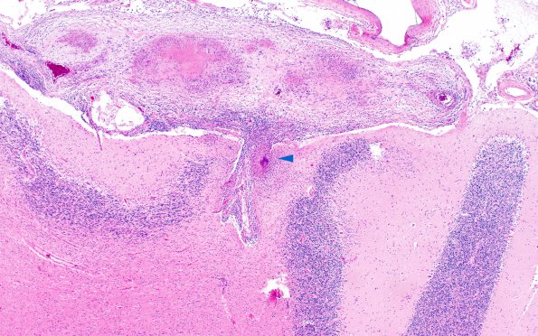 1I3 Neurosarcoidosis (Case 1) N9 H&E 2 copy