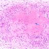 1I4 Neurosarcoidosis (Case 1) N9 H&E 3 copy