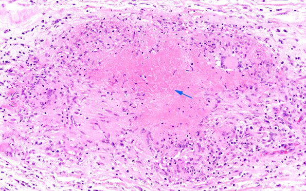 1I4 Neurosarcoidosis (Case 1) N9 H&E 3 copy