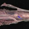 1J Neurosarcoid (Case 1) _9 copy