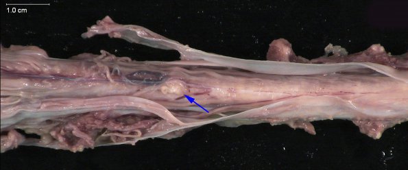 1J Neurosarcoid (Case 1) _9 copy