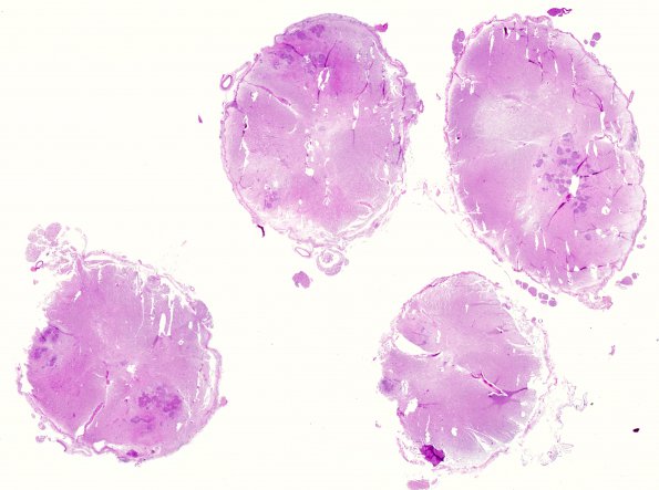 1J Neurosarcoidosis (Case 1) N10 H&E whole mount