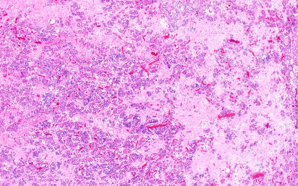 1K Neurosarcoidosis (Case 1) Pituitary H&E 4X A