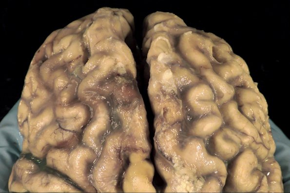 2A1 Neurosarcoid (Case 2) _4