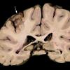 2A2 Neurosarcoid (Case 2) _6 copy