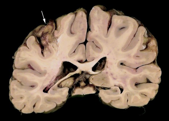 2A2 Neurosarcoid (Case 2) _6 copy