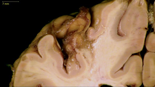 2A3 Neurosarcoid (Case 2) _7