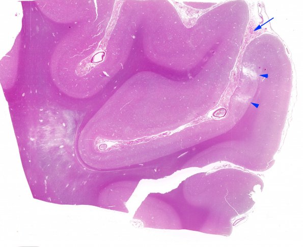 2B1 Neurosarcoid (Case 2) N5 H&E whole mount copyA