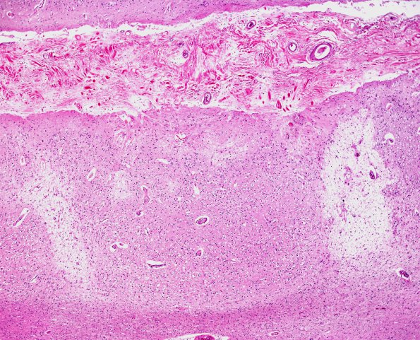 2B2 Neurosarcoid, post Rx (Case 2) N5 H&E 4X 2