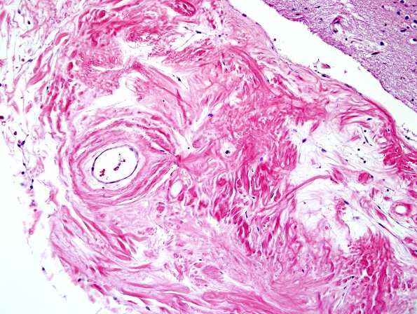 2B3 Neurosarcoid, post Rx (Case 2) N5 H&E 6