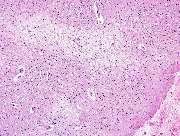 2B4 Neurosarcoid, post Rx (Case 2) N5 H&E 4X 1