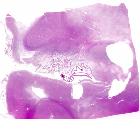 2B5 Neurosarcoid, post Rx (Case 2) N16 H&E whole mount