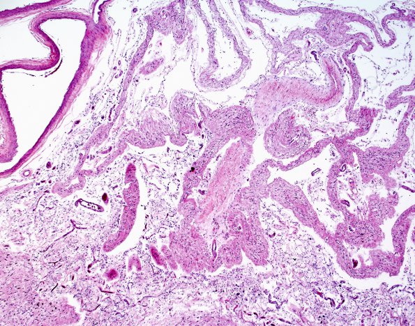 2B6 Neurosarcoid, post Rx (Case 2) N5 H&E 1