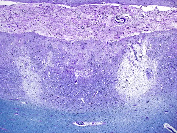 2C Neurosarcoid, post Rx (Case 2) N5 LFB-PAS 4X