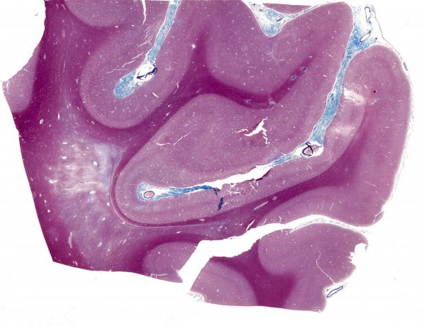 2E1 Neurosarcoid (Case 2) N5 Trichrome whole mount