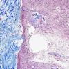 2E2 Neurosarcoid (Case 2) N5 Trichrome 2