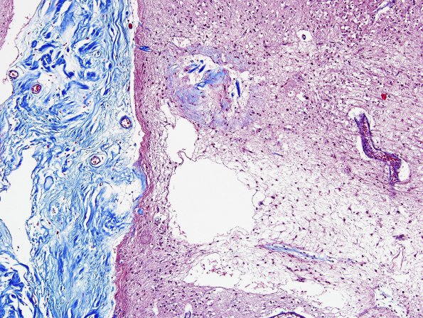 2E2 Neurosarcoid (Case 2) N5 Trichrome 2