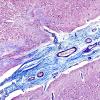 2E3 Neurosarcoid (Case 2) N5 Trichrome 4