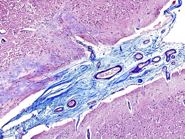 2E3 Neurosarcoid (Case 2) N5 Trichrome 4