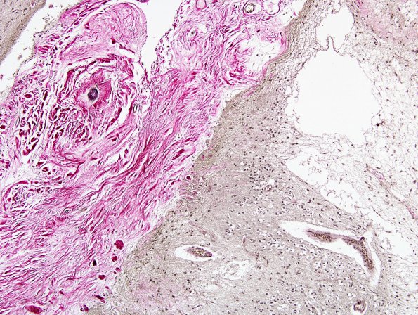 2F2 Neurosarcoid (Case 2) N5 Elastin 3