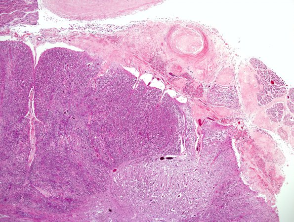 2G1 Neurosarcoid, post Rx (Case 2) N10 H&E 6