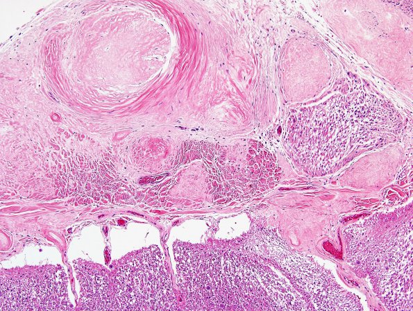 2G2 Neurosarcoid (Case 2) N10 H&E 1A