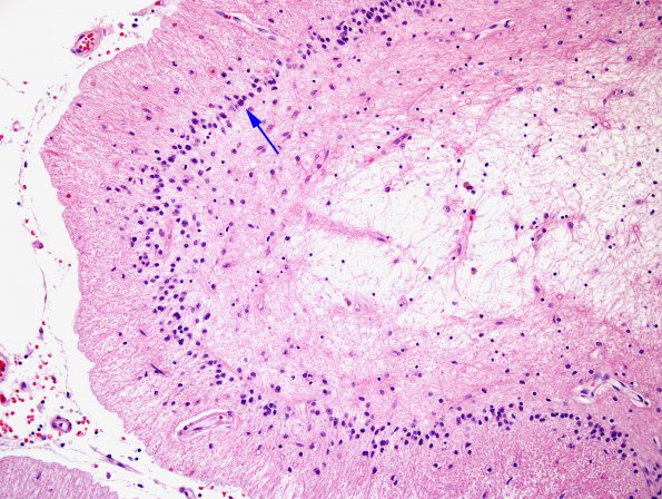 2H3 Neurosarcoid, post Rx (Case 2) N6 H&E 4 copy