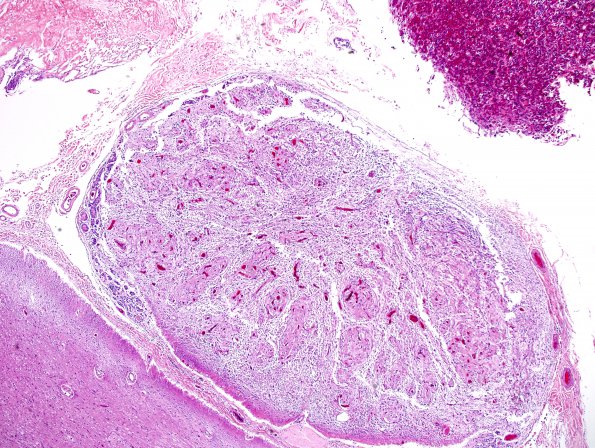 2I Neurosarcoid, pituitary stalk (Case 2) H&E 3