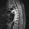 3A2 Granulomatous Inflammation cw sarcoid (Case 3) T1 W2 - Copy