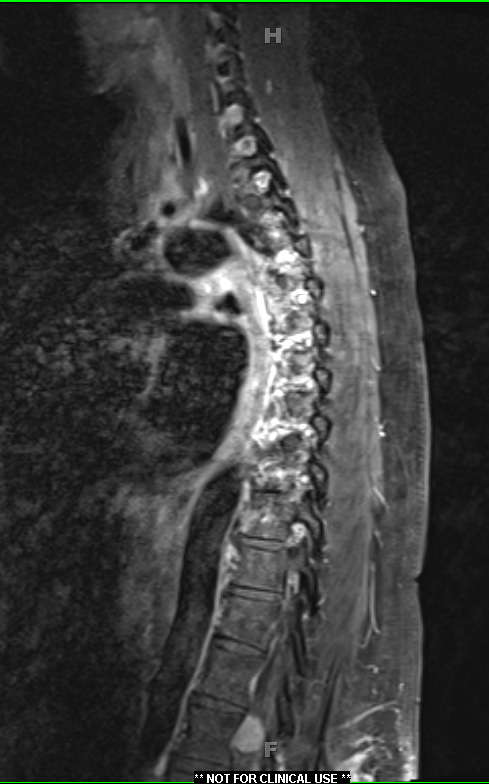 3A2 Granulomatous Inflammation cw sarcoid (Case 3) T1 W2 - Copy