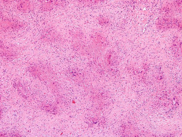 3B1 Granulomatous Inflammation cw sarcoid (Case 3) H&E 10X 3