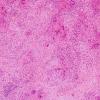 3B2 Granulomatous Inflammation cw sarcoid (Case 3) H&E 10X 2