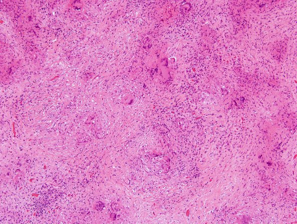 3B2 Granulomatous Inflammation cw sarcoid (Case 3) H&E 10X 2