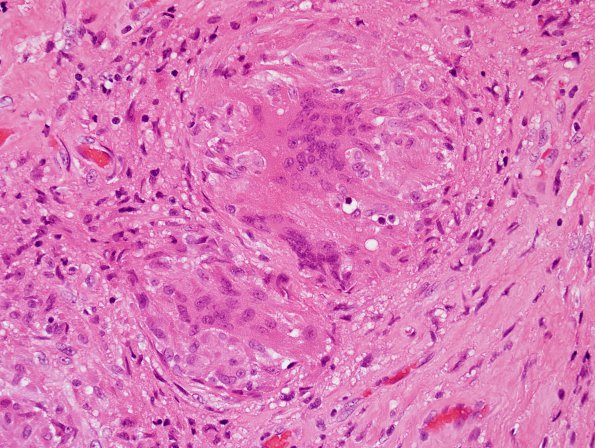 3B3 Granulomatous Inflammation cw sarcoid (Case 3) H&E 3