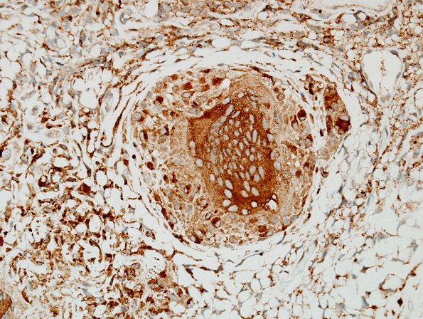 3C3 Granulomatous Inflammation cw sarcoid (Case 3) CD68 6