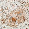 3C4 Granulomatous Inflammation cw sarcoid (Case 3) CD68 13