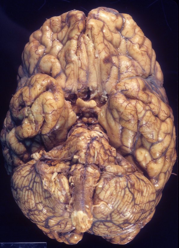 4A1 Neurosarcoid (Case 4) 1