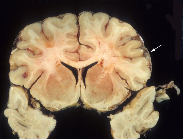 4A2 Neurosarcoid (Case 4) 2 copy