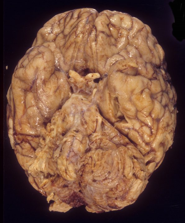 5A1 Neurosarcoid (Case 5) 1