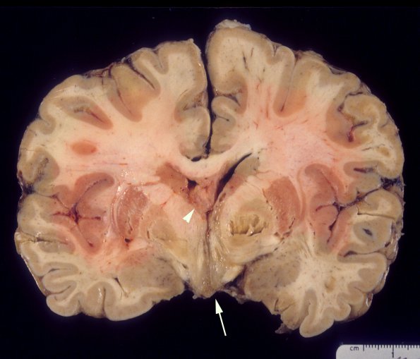 5A2 Neurosarcoid (Case 5) 4 copy