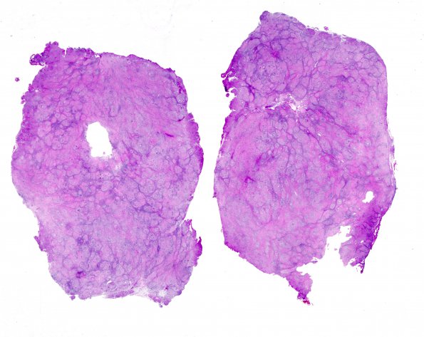 6A1 Neurosarcoid (Case 6) H&E whole mount