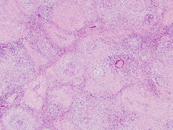 6A3 Neurosarcoid (Case 6) H&E 6