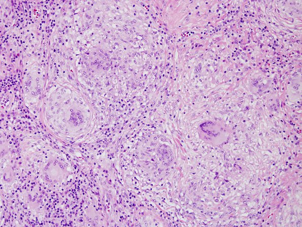 6A4 Neurosarcoid (Case 6) H&E 3