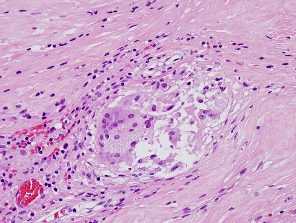 6A5 Neurosarcoid (Case 6) H&E 4